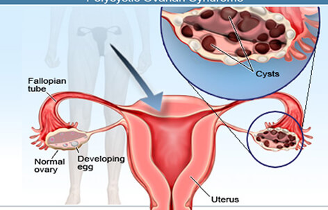 파일:external/images.onhealth.com/ovarian-cysts-s3-cysts-types.jpg