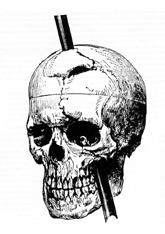 파일:external/upload.wikimedia.org/Phineas_gage_-_1868_skull_diagram.jpg