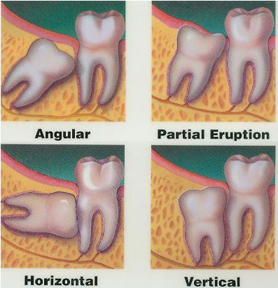 파일:external/www.dentalindia.com/wistooth2.jpg