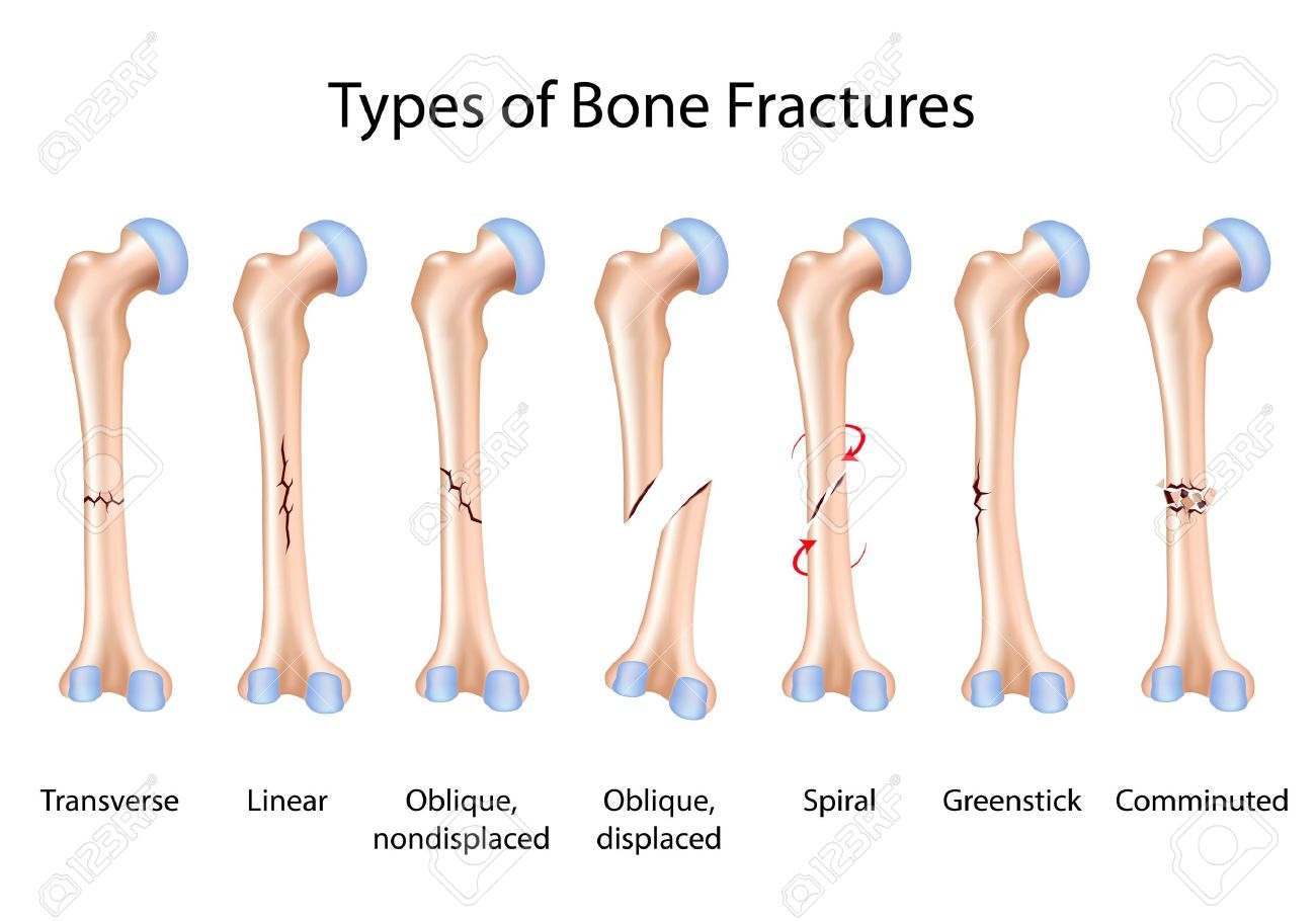 파일:external/previews.123rf.com/16801387-Types-of-bone-fractures-Stock-Vector-bone-fracture-femur.jpg