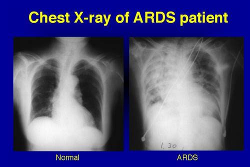 파일:external/www.omicsgroup.org/acute-respiratory-distress-syndrome-6136.jpg
