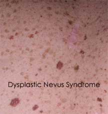 파일:external/www.orlandoskindoc.com/Dysplastic-Nevus-Syndrome.jpg